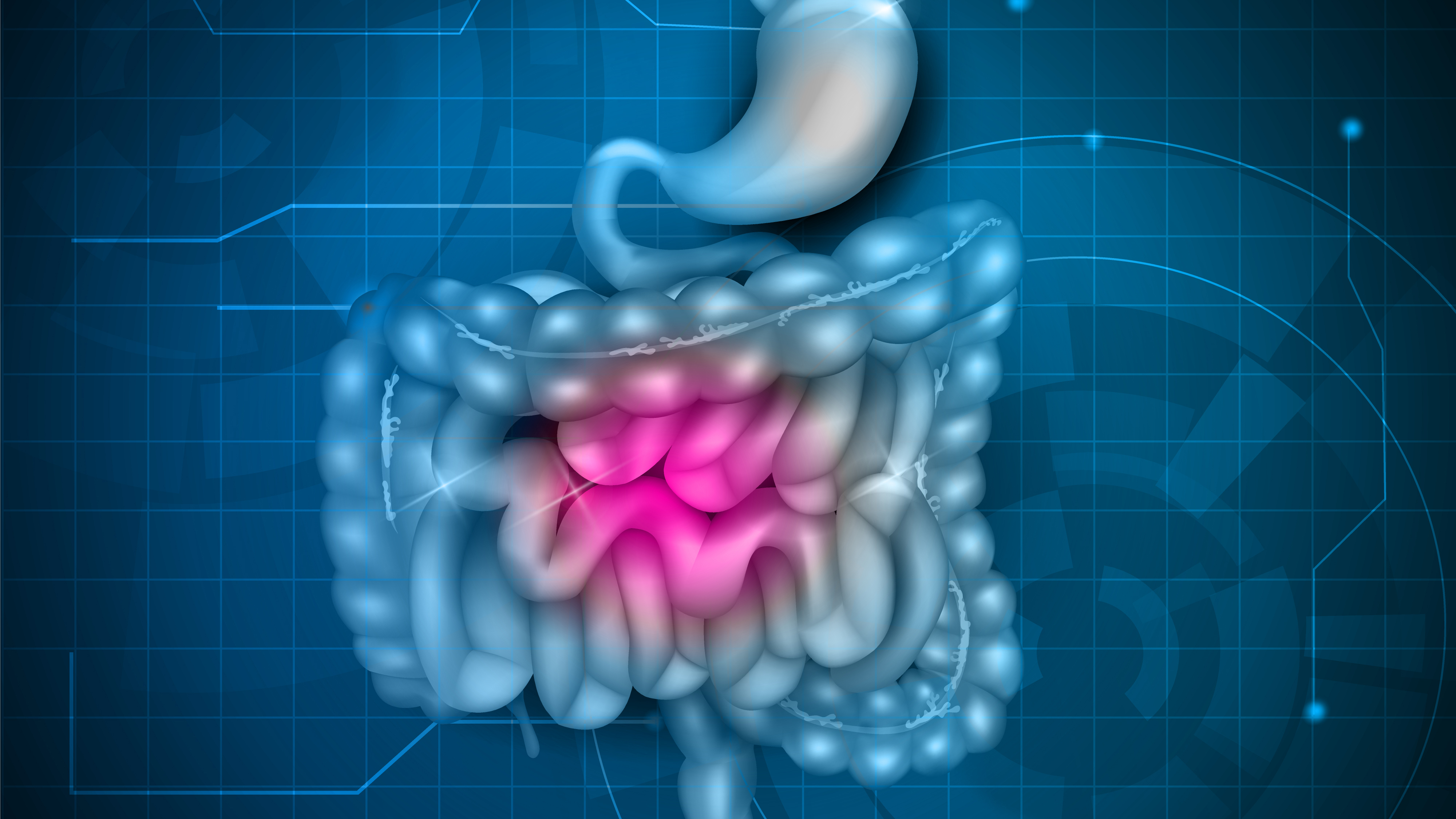 IBS, irritable bowel syndrome 